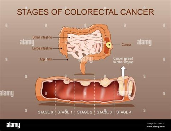 Colorectal Cancers Are Spiking in People Under 55—These Are the First Signs